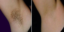 Load image into Gallery viewer, Laser under arm 10 session (male & female(