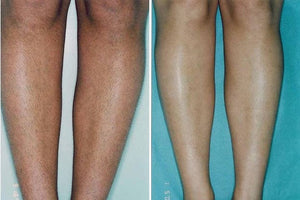 Laser half leg area (incl knee) 1 session (male&female)