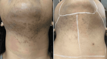 Load image into Gallery viewer, Laser Treatment For Hair Removal Full Neck 10 session