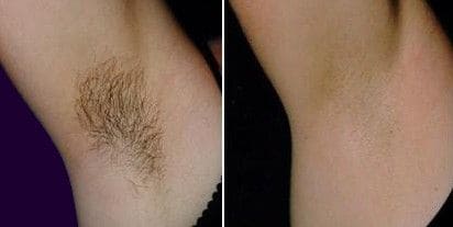 Laser under arm 1 session (Male and female)
