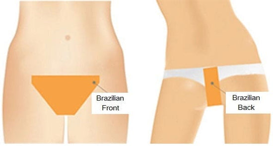 Laser Treatment For Hair Removal  Full Bikini Area 10 session (male and female)