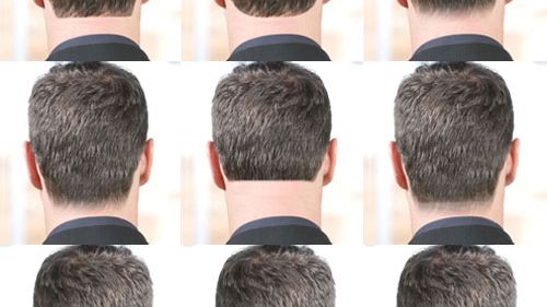 Laser Treatment For Hair Removal  For Neck Area 1 session (male & female)