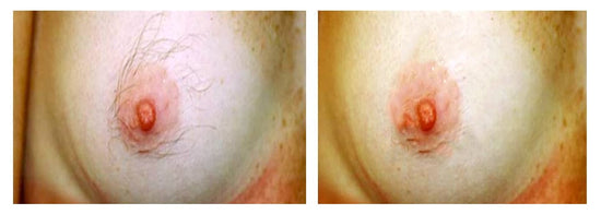 Laser areola area 1 session