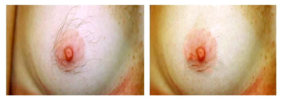 Laser areola area 1 session
