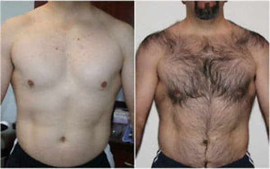 Laser chest area 1 session