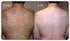 Laser back area 1 session