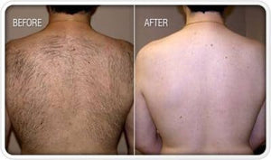 Laser back area 1 session