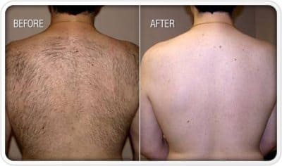 Laser back area 1 session