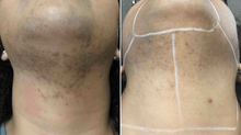 Load image into Gallery viewer, Laser full neck 1 session (male &amp; female)
