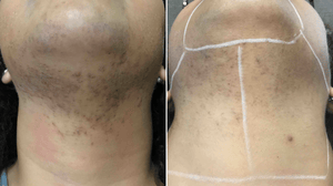 Laser full neck 1 session (male & female)