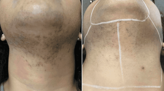 Laser Treatment For Hair Removal  Full Neck 10 session